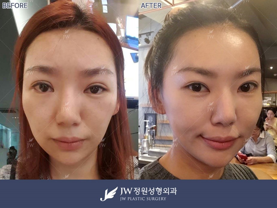 Triple eyelid discount surgery